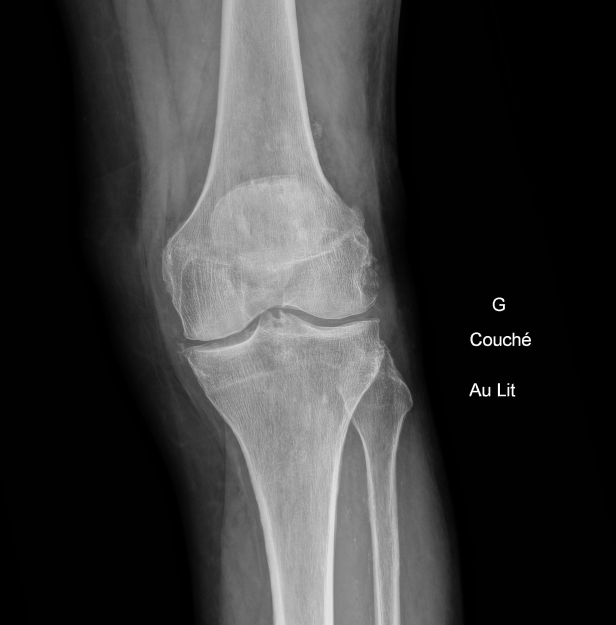 75 YO man ,trauma 
