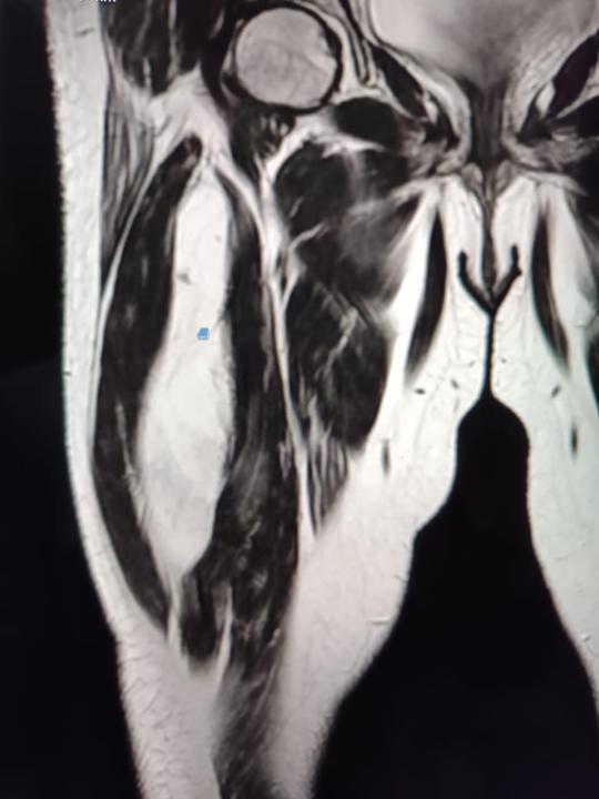Intramuscular lipoma..