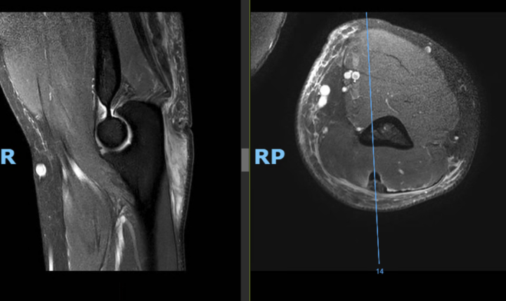 Probable partial rupture of the triceps tendon.