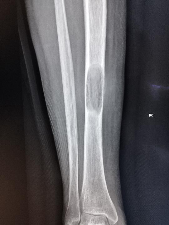 Bone lesion in systemic disease
