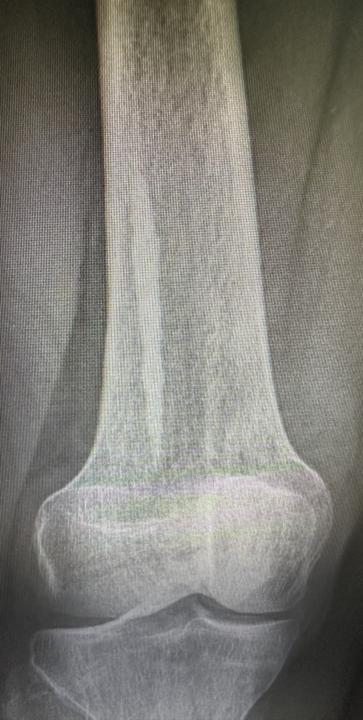 Long sclerotic bone lesion distal femur