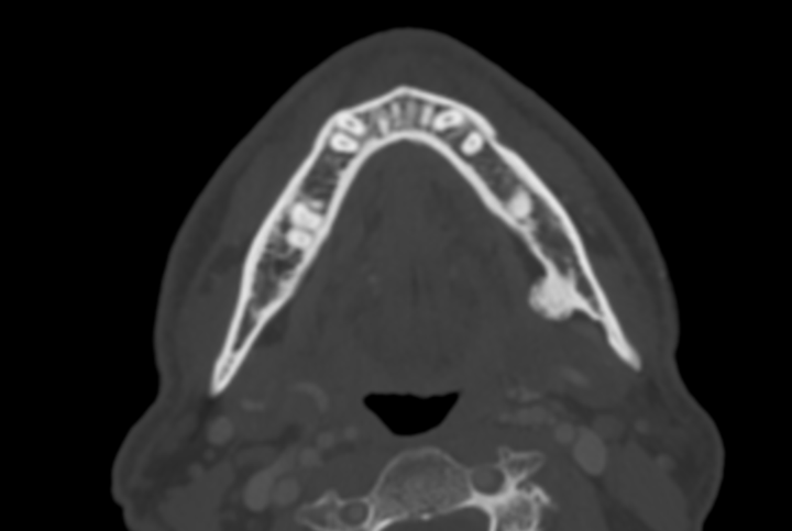 Bony Mandible lesion