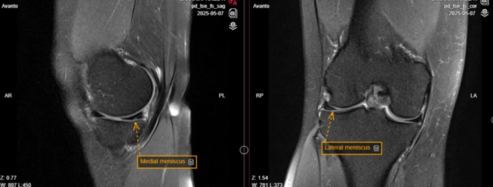 Questionable meniscal hyperintensities. 
