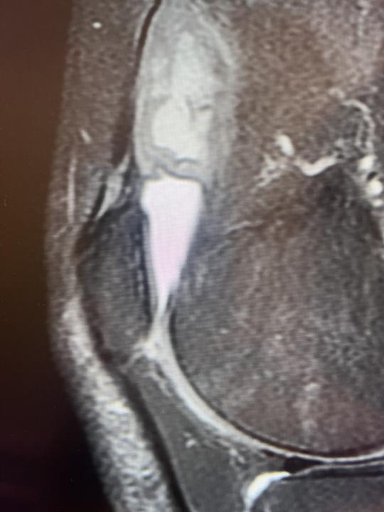 Suprapatellar lesion