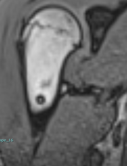 Shoulder trauma , incidental image