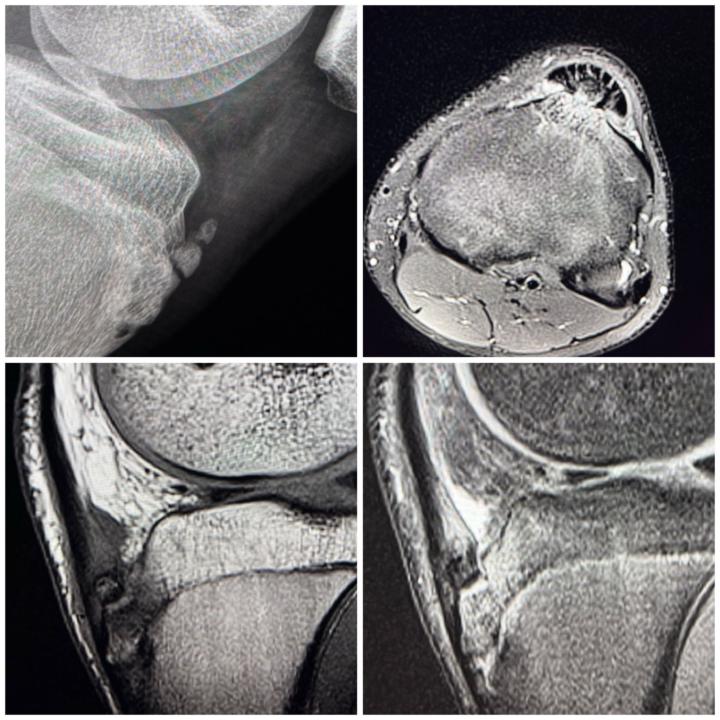 ⚜️Osgood-Schlatter disease