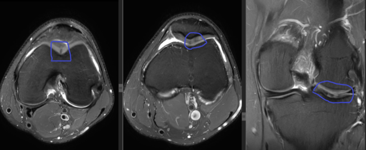 Could this be "black line sign" of cartilage?