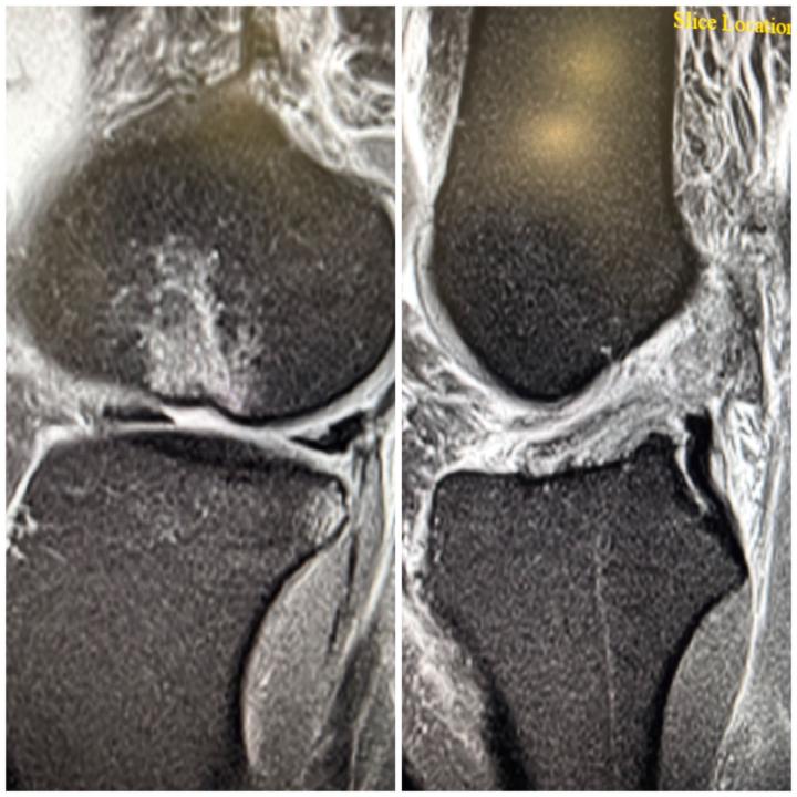 Lateral Femoral Sulcus Sign