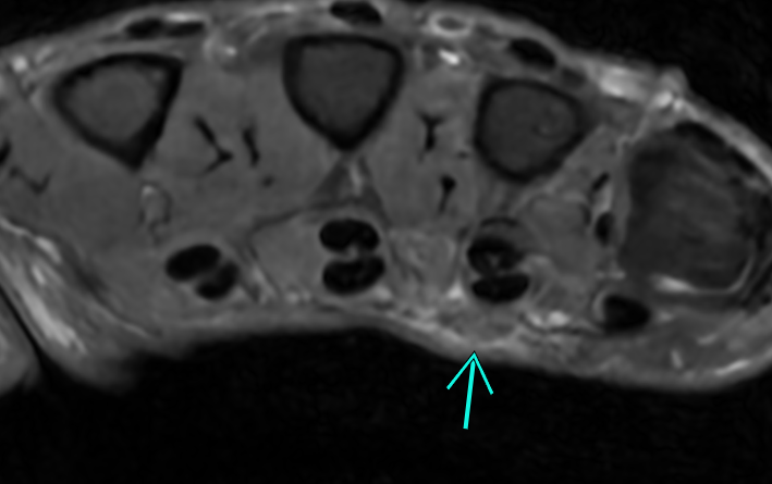 Duyputren's disease on MRI