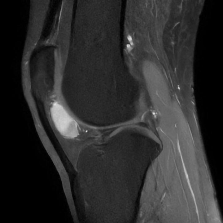 Tumor-Quiz: Knee
