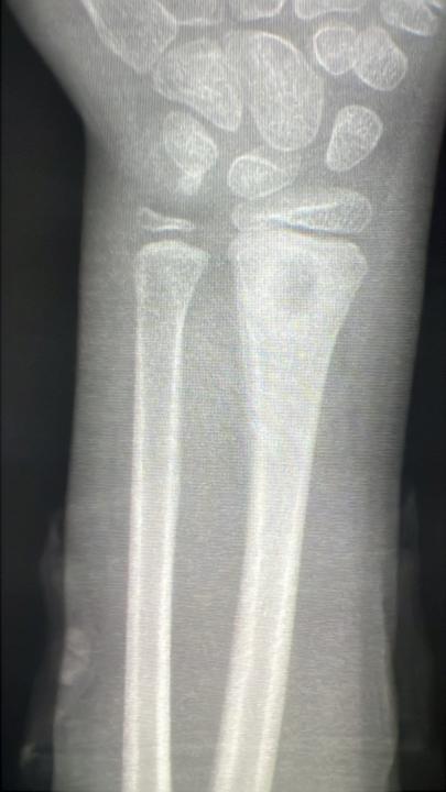 7 year female , history of trauma later on develop this lesion 