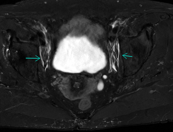 lymphatic edema?