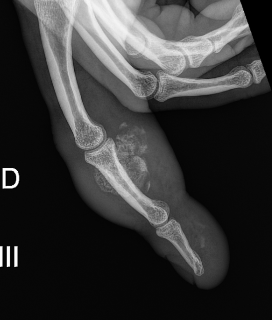 Need help with this finger case ( NORA ?)