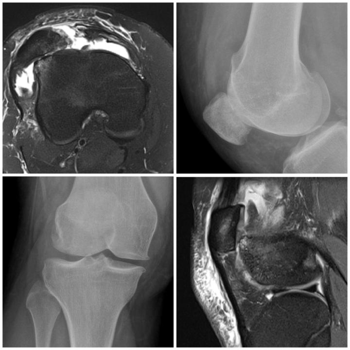 Trochlear dysplasia with MPFL tear