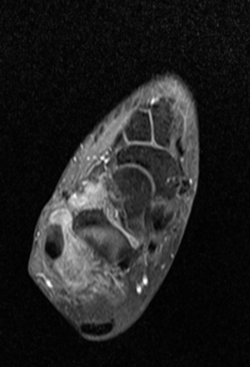 Ankle MRI