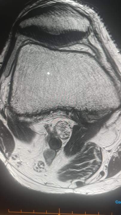 Popliteal fossa lesion