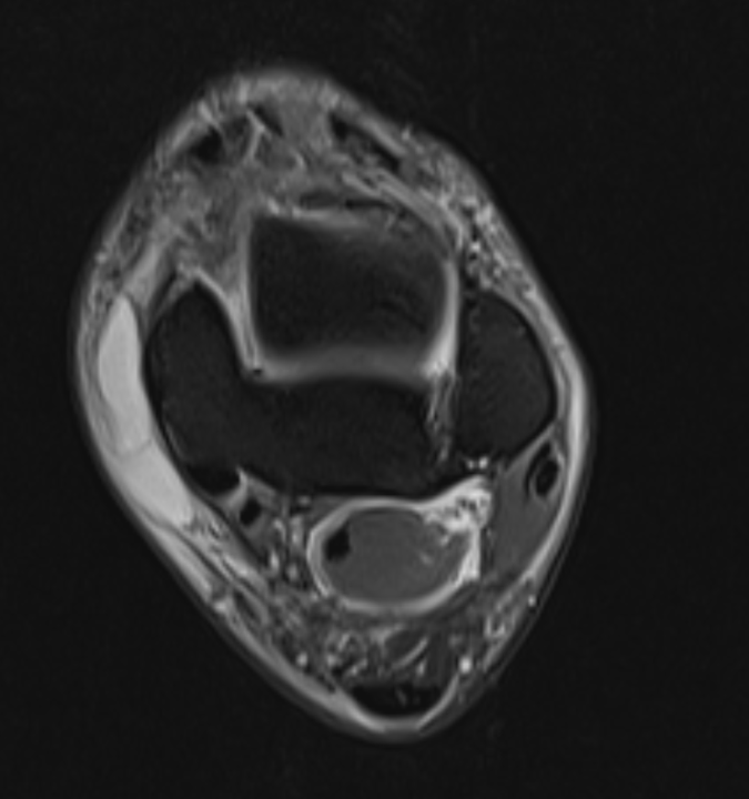 Ankle injury