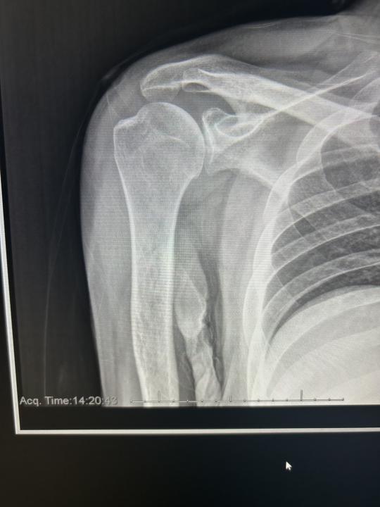 Humerus MRI