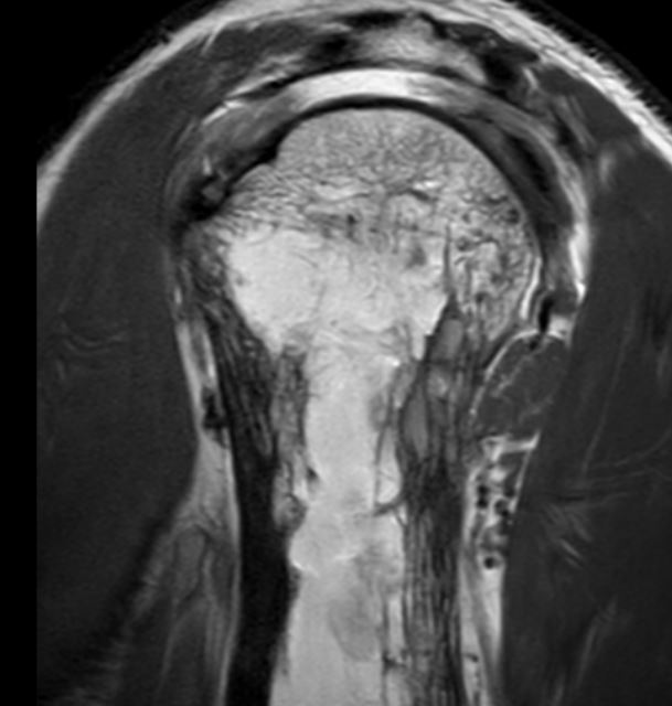 Humerus - Quiz