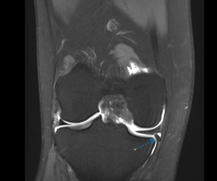 Knee MR arthrography.  