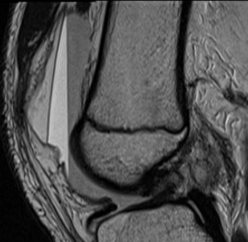 Lipohemarthrosis and gravity