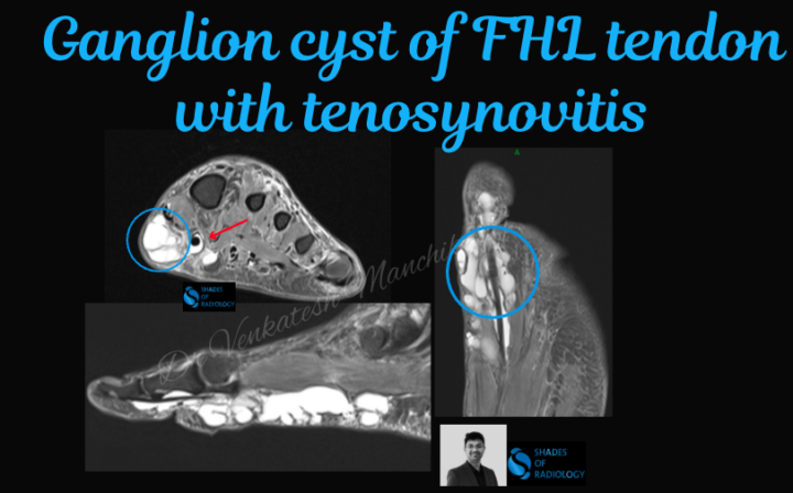 Large Ganglion Cyst of the Flexor Hallucis Longus (FHL) Tendon