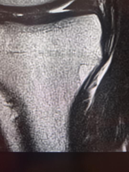 Proximal tibial lesion