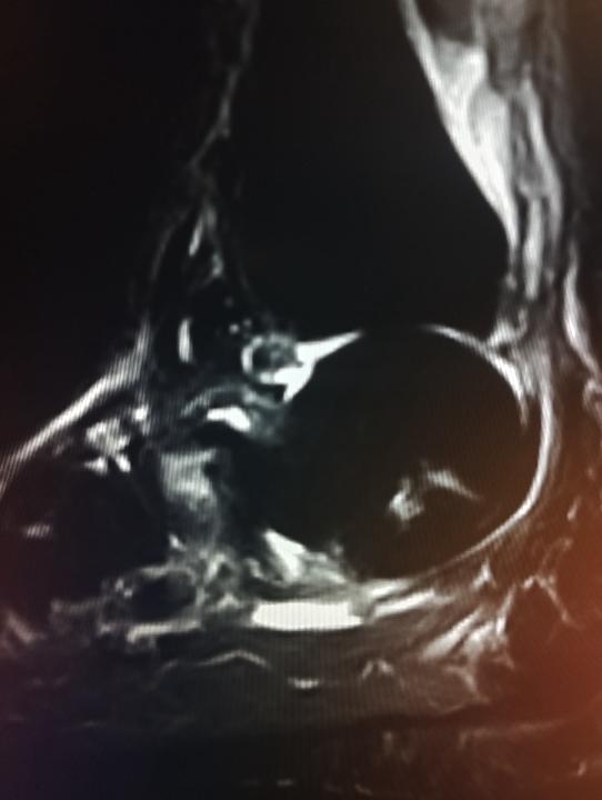 Midfoot atraumatic pain