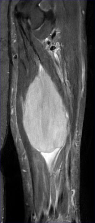 Primary and secondary (muscle) lymphoma