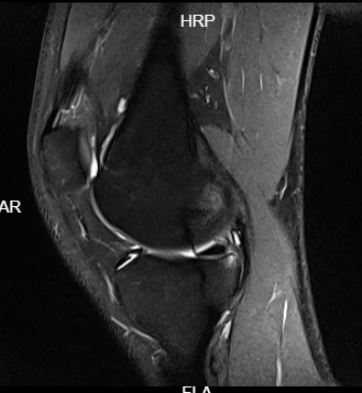 25 year old knee pain after a football match