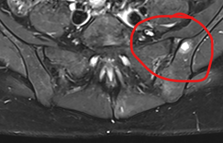 Incidental lesion on pelvic MRI 