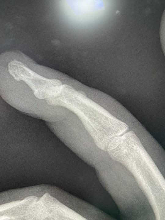 Fracture?