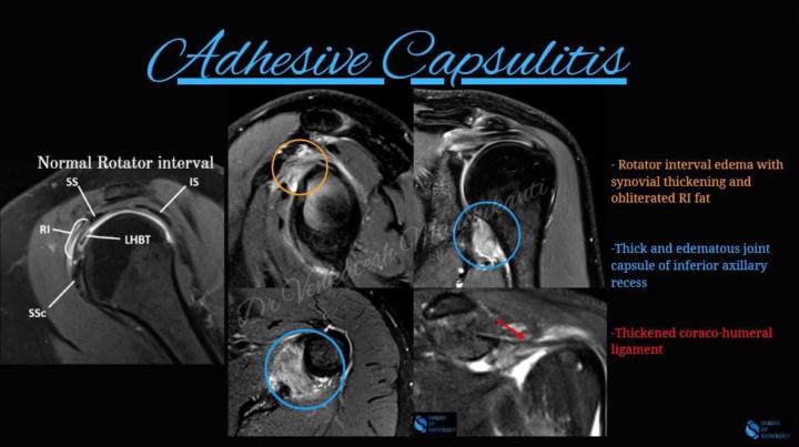 Adhesive Capsulitis 