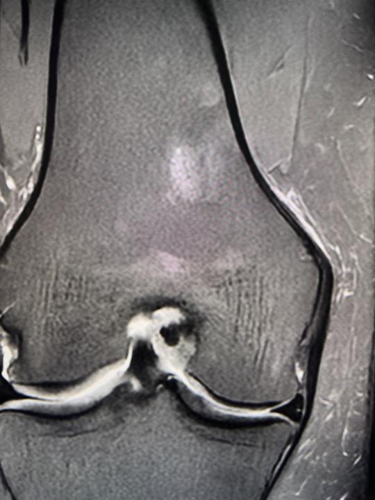 Focal area in distal femoral bone