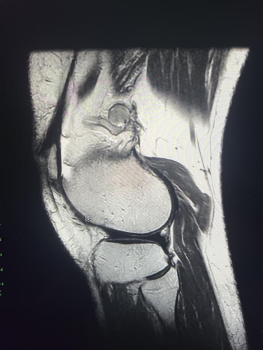 Knee pain