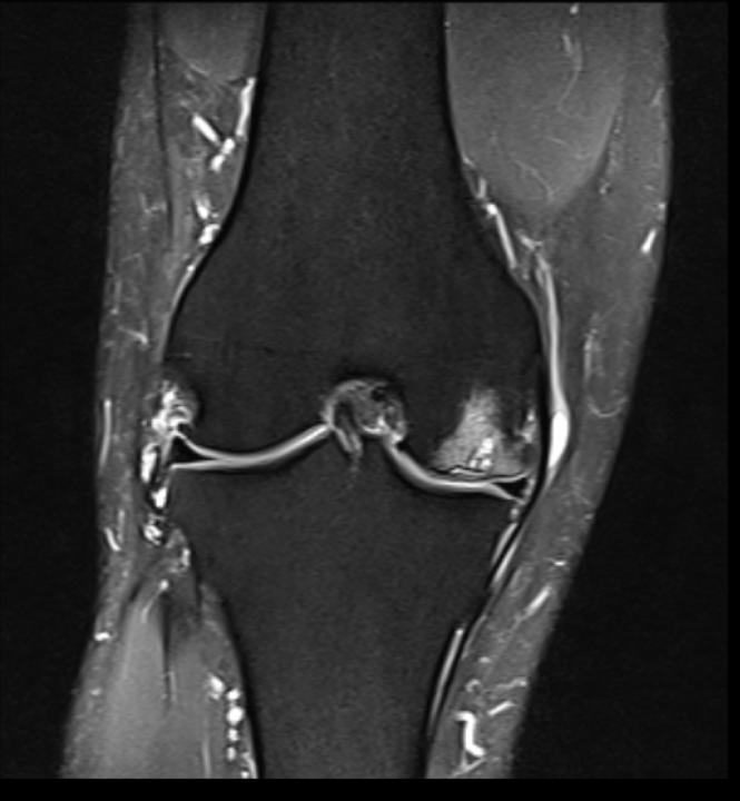 Knee MRI