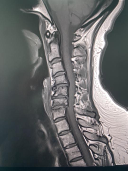 Spondylodiscitis vs spondyloartritis?