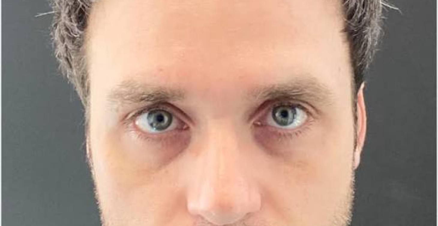 Periorbital Area