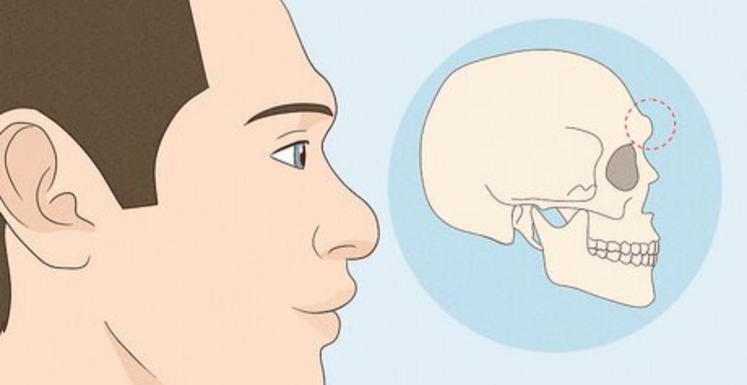 Supraorbital Ridge (Browridge)
