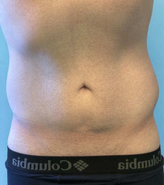 Hormonal abdomen finally shrinking?