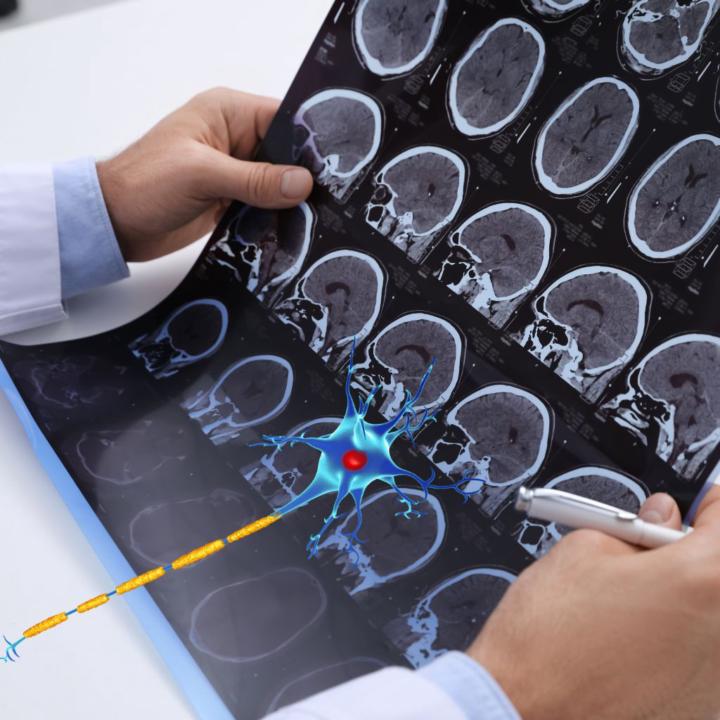 Multiple Sklerose: Ein Blick auf Krankheit, Therapie und Markt