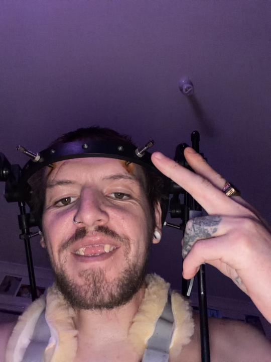 Anyone else suffer from serious accidents and how have you copped with the recovery