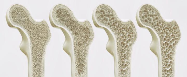Guess Your Bone Density Stage: 1 (Strong) or 4 (Brittle)? Ladies, This Is Important!