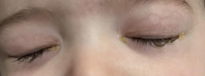 I think my baby has pink eye😞