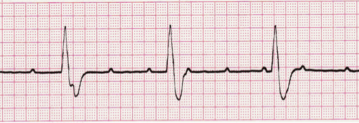 ECG Interpretation