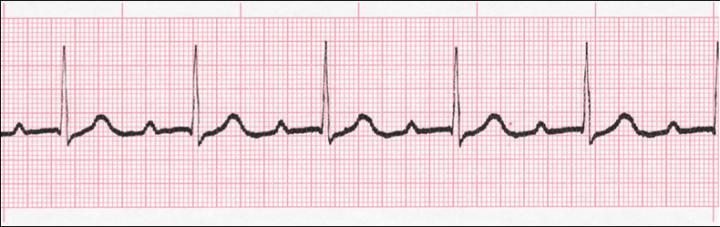 ECG interpretation