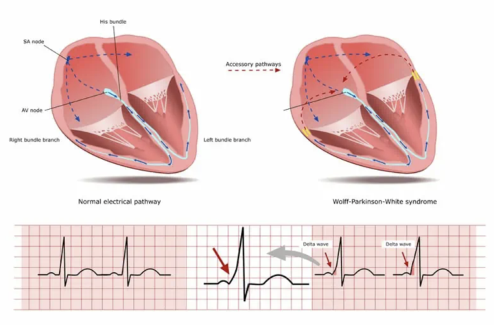 WPW Syndrome