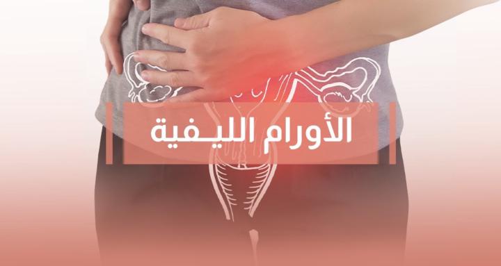 الاورام الليفية 