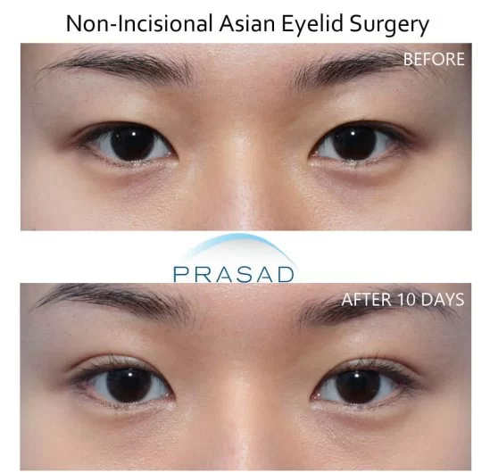 Non-incisional-Asian-double-eyelid-surgery-before-and-after-10-days-1-1-qjg96zoh5yp41kjjep298jyrgmbtgve0gx9go3ey9g.webp