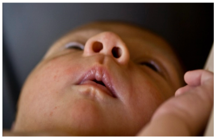 When the tongue is restricted - lip blisters or callus's often arise. Here's an image